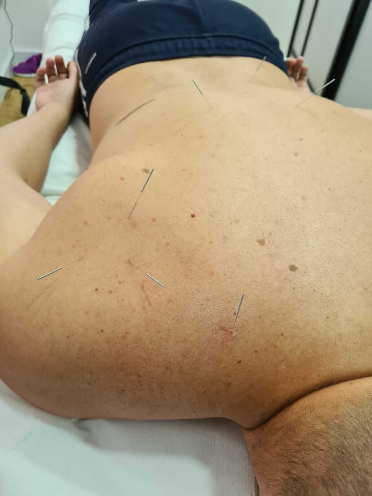 dry-needling